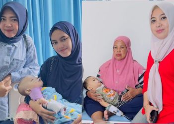 Dua Bayi asal Pohuwato Sukses Operasi Celah Bibir di Makassar