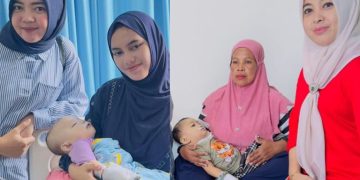 Dua Bayi asal Pohuwato Sukses Operasi Celah Bibir di Makassar